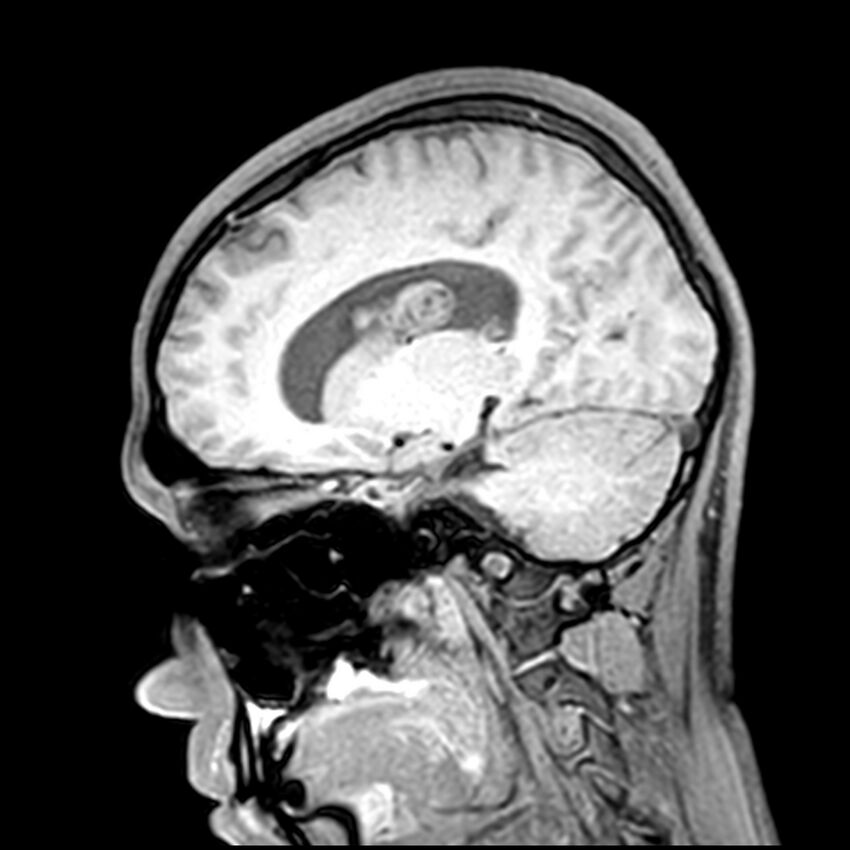 Central neurocytoma (Radiopaedia 79320-92380 Sagittal T1 105).jpg