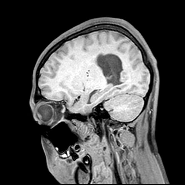 File:Central neurocytoma (Radiopaedia 79320-92380 Sagittal T1 180).jpg