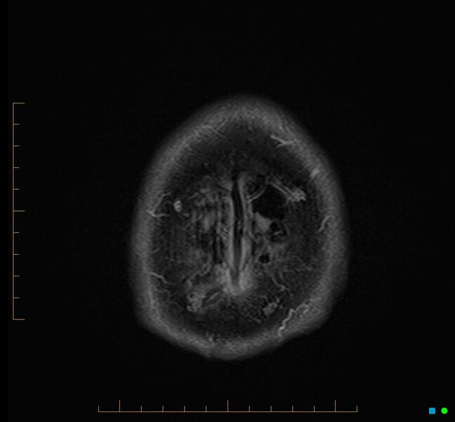File:Cerebellar gangliocytoma (Radiopaedia 65377-74422 Axial FLAIR 38).jpg
