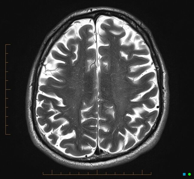File:Cerebellar gangliocytoma (Radiopaedia 65377-74422 Axial T2 28).jpg