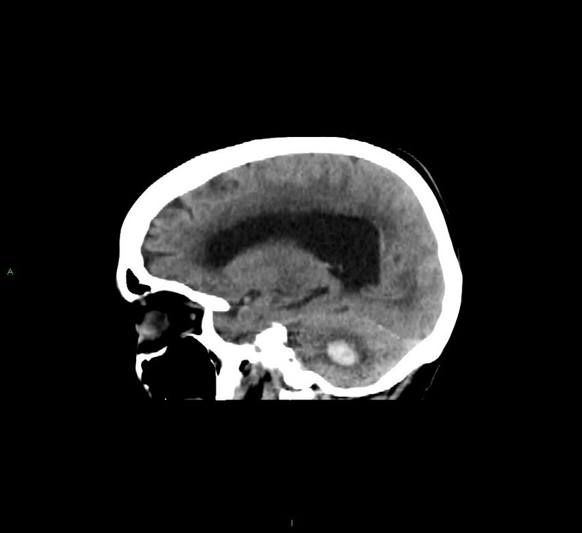 Cerebellar hemorrhage (Radiopaedia 58793-66027 C 20).jpg