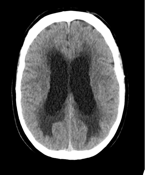 File:Cerebellar metastasis from lung adenocarcinoma (Radiopaedia 86690-102828 Axial non-contrast 19).png