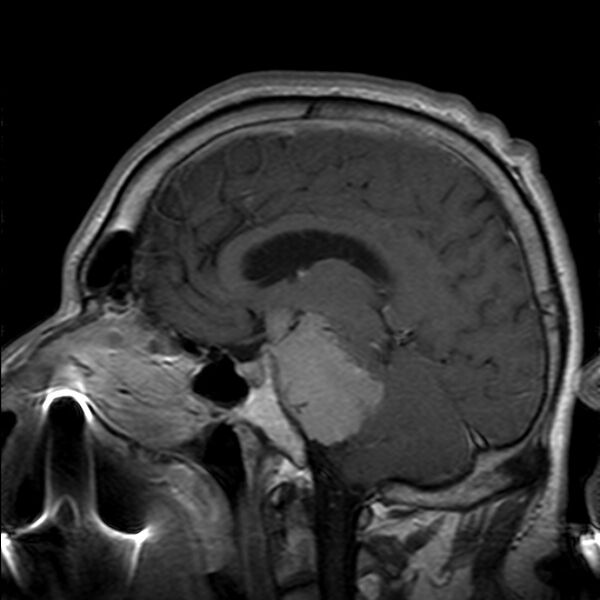 File:Cerebellopontine angle meningioma (Radiopaedia 24459-24764 Sagittal T1 C+ 12).jpg