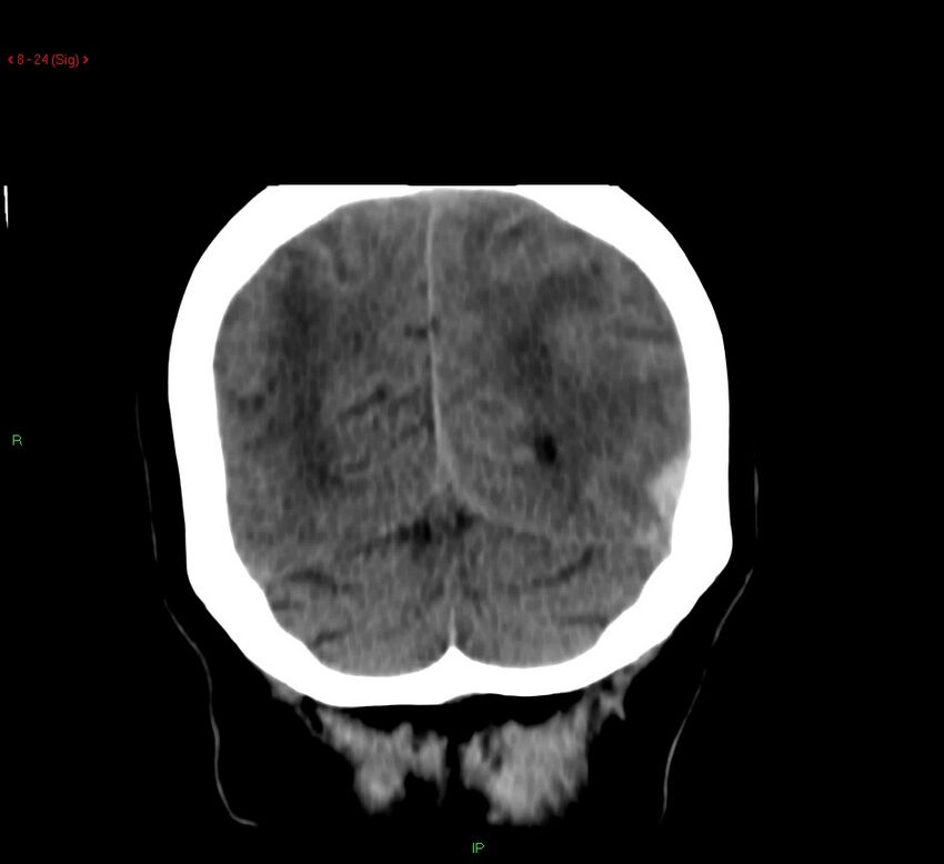 Cerebral amyloid angiopathy-associated lobar intracerebral hemorrhage (Radiopaedia 58378-65518 Coronal non-contrast 24).jpg