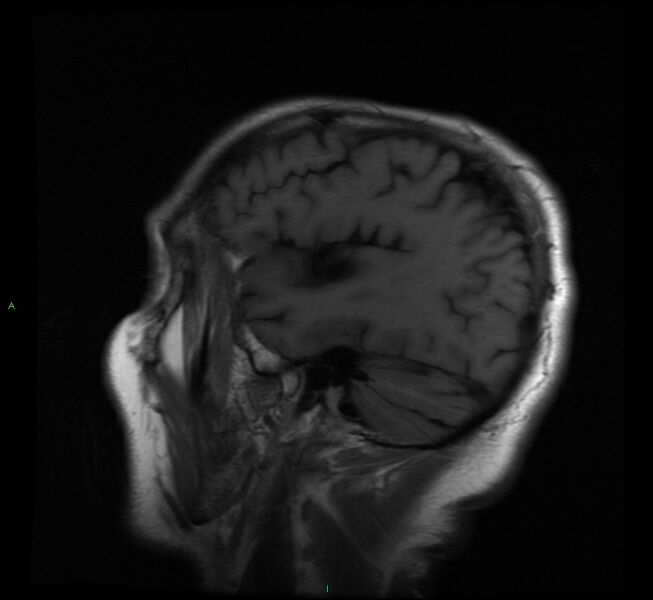 File:Cerebral amyloid angiopathy-associated lobar intracerebral hemorrhage (Radiopaedia 58529-65684 Sagittal T1 5).jpg