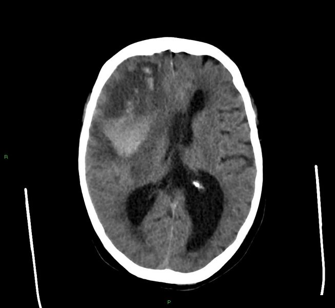 File:Cerebral amyloid angiopathy-associated lobar intracerebral hemorrhage (Radiopaedia 58560-65723 Axial non-contrast 26).jpg
