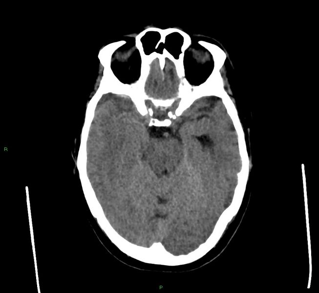 File:Cerebral amyloid angiopathy-associated lobar intracerebral hemorrhage (Radiopaedia 58560-65723 Axial non-contrast 35).jpg