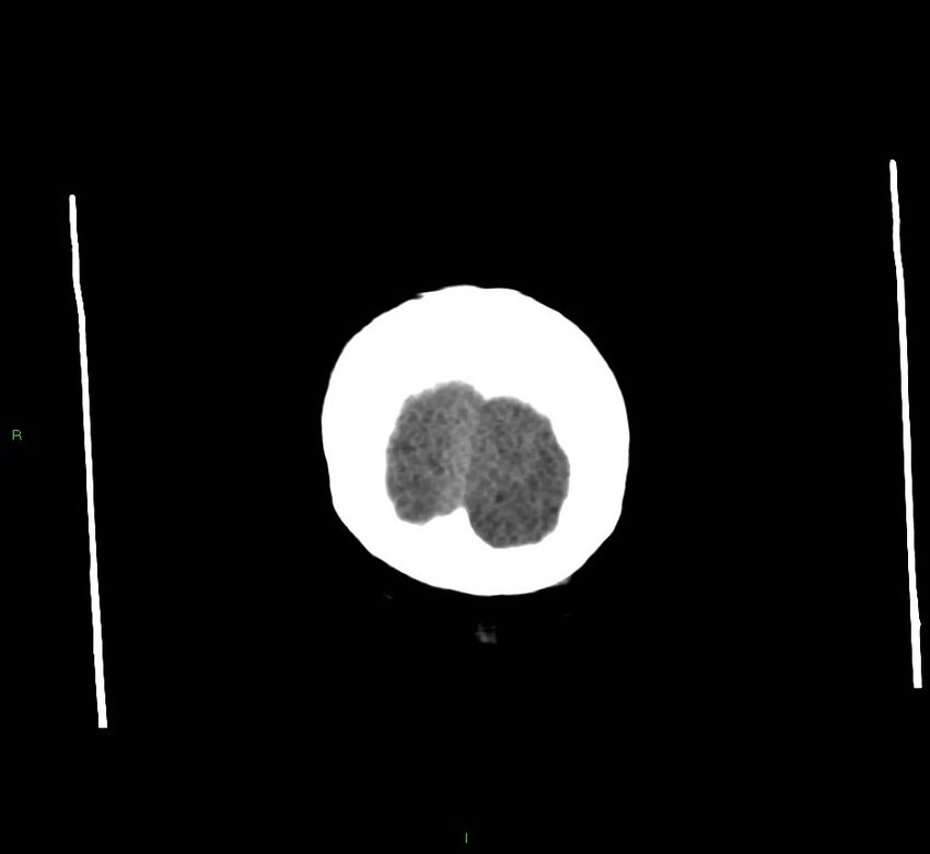 Cerebral amyloid angiopathy-associated lobar intracerebral hemorrhage (Radiopaedia 58560-65723 Coronal non-contrast 6).jpg