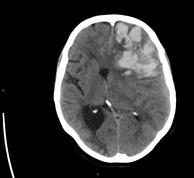 File:Cerebral amyloid angiopathy-associated lobar intracerebral hemorrhage (Radiopaedia 58561-65724 Axial non-contrast 24).jpg