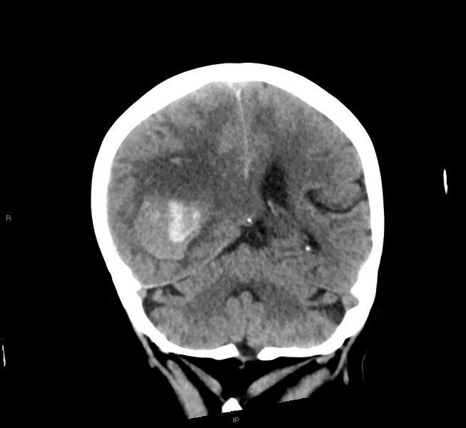 File:Cerebral amyloid angiopathy-associated lobar intracerebral hemorrhage (Radiopaedia 58563-65727 Coronal non-contrast 26).jpg