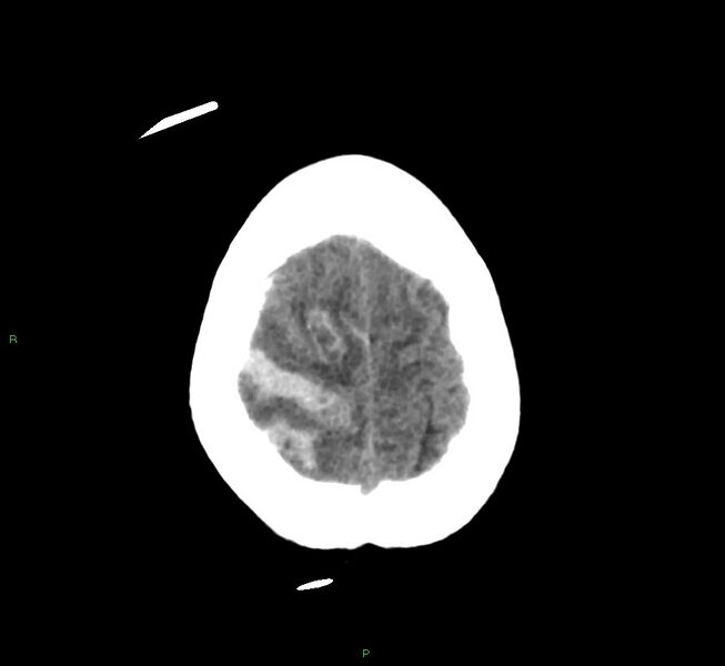 File:Cerebral amyloid angiopathy-associated lobar intracerebral hemorrhage (Radiopaedia 58566-65730 Axial non-contrast 8).jpg