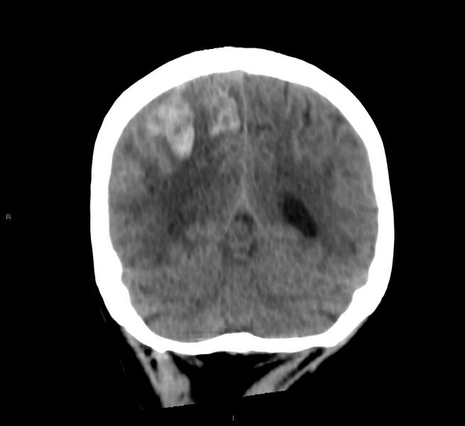 File:Cerebral amyloid angiopathy-associated lobar intracerebral hemorrhage (Radiopaedia 58566-65730 Coronal non-contrast 23).jpg