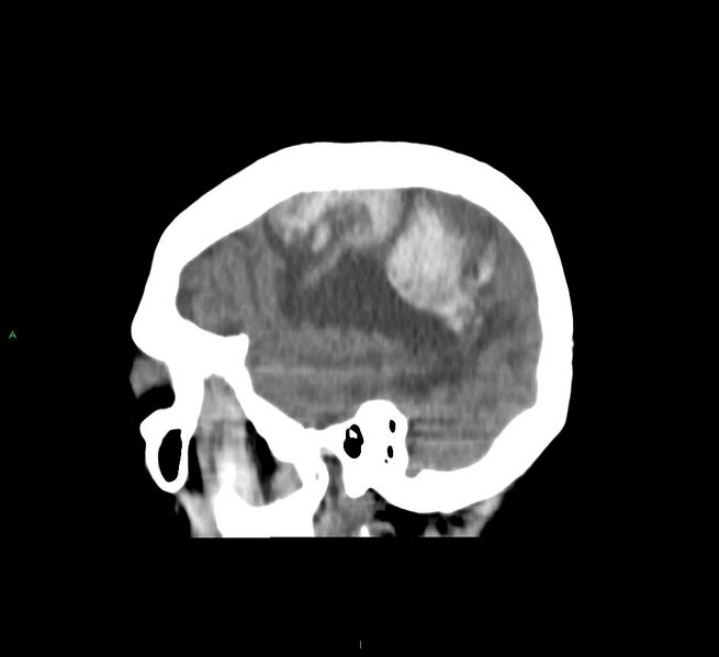 File:Cerebral amyloid angiopathy-associated lobar intracerebral hemorrhage (Radiopaedia 58751-65972 C 14).jpg