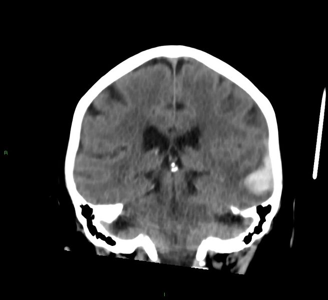 File:Cerebral amyloid angiopathy-associated lobar intracerebral hemorrhage (Radiopaedia 58757-65978 Coronal non-contrast 29).jpg