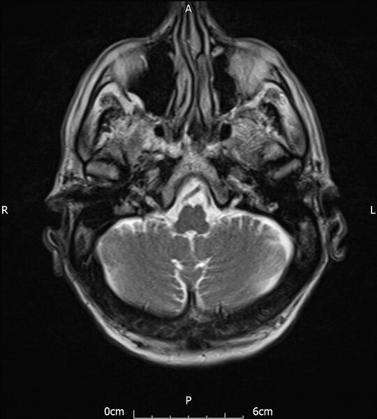 File:Cerebral amyloid angiopathy related inflammation (Radiopaedia 72772-83415 Axial T2 5).jpg