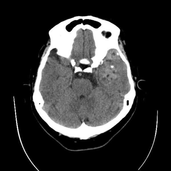File:Cerebral arteriovenous malformation (Radiopaedia 43729-47189 Axial non-contrast 12).jpg