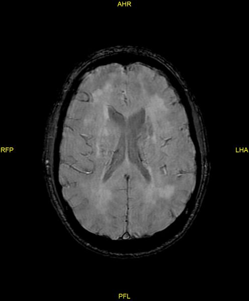 File:Cerebral autosomal dominant arteriopathy with subcortical infarcts and leukoencephalopathy (CADASIL) (Radiopaedia 86108-102054 Axial SWI 66).jpg