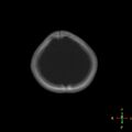 Cerebral contusion (Radiopaedia 48869-53911 Axial bone window 3).jpg