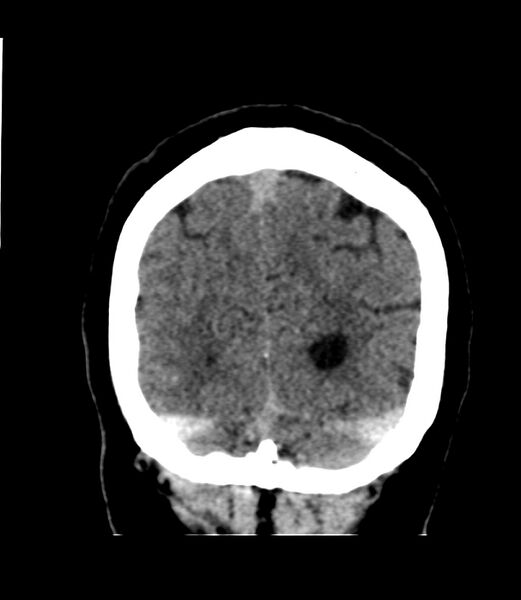 File:Cerebral dural venous sinus thrombosis (Radiopaedia 86514-102575 Coronal non-contrast 46).jpg
