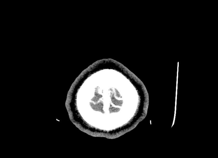 Cerebral edema (Radiopaedia 82519-96661 B 6).jpg
