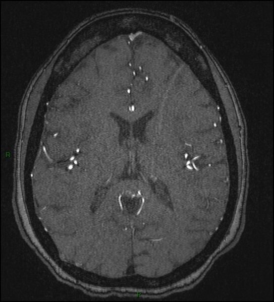 File:Cerebral fat embolism (Radiopaedia 35022-36525 Axial TOF 122).jpg