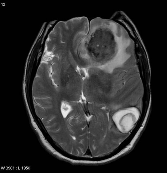 File:Cerebral metastases - renal cell carcinoma (Radiopaedia 5510-7246 Axial T2 2).jpg