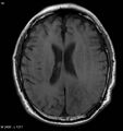 Cerebral radiation necrosis (Radiopaedia 5665-7376 Axial T1 1).jpg