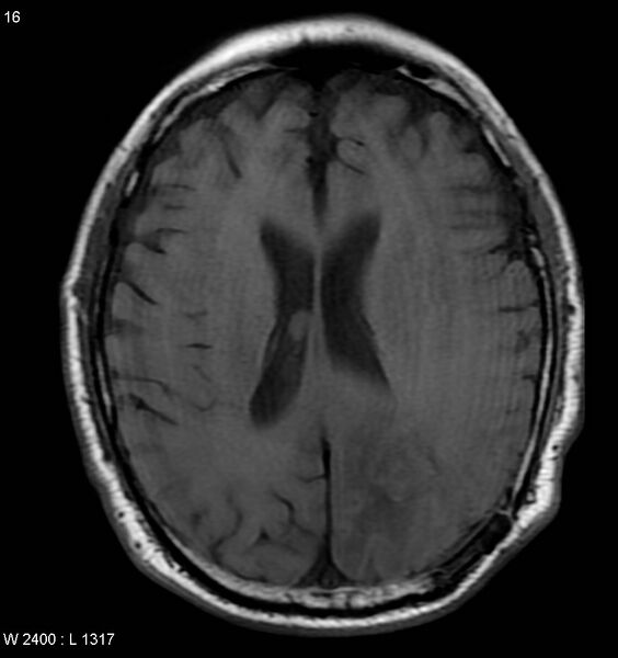 File:Cerebral radiation necrosis (Radiopaedia 5665-7376 Axial T1 1).jpg