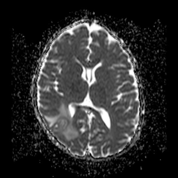 File:Cerebral tuberculoma (Radiopaedia 41152-43932 Axial ADC 12).jpg