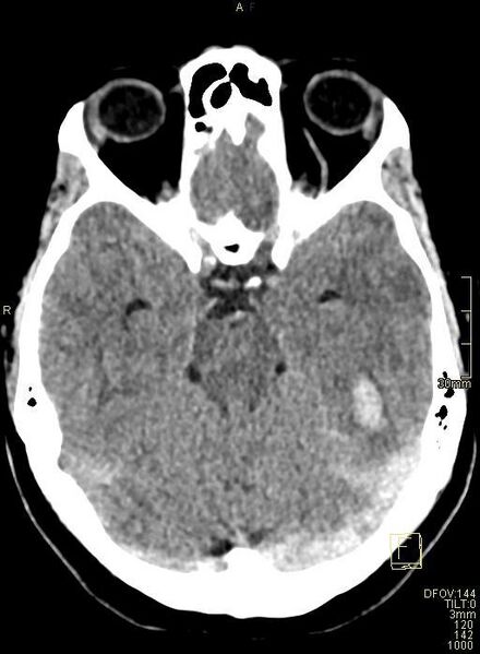 File:Cerebral venous sinus thrombosis (Radiopaedia 91329-108965 Axial non-contrast 18).jpg