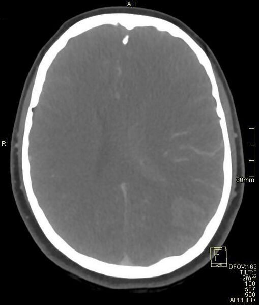 File:Cerebral venous sinus thrombosis (Radiopaedia 91329-108965 Axial venogram 50).jpg