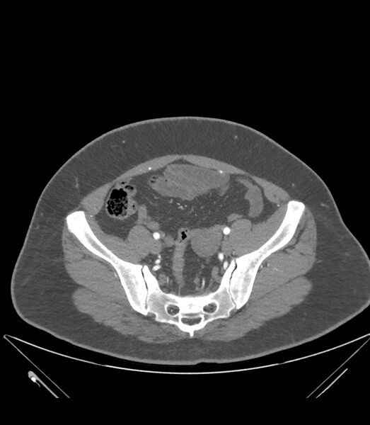 File:Cervical aortic arch with coarctation and aneurysms (Radiopaedia 44035-47552 B 72).jpg