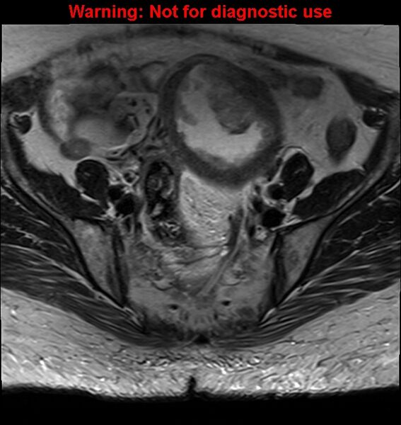 File:Cervical cancer (Radiopaedia 24151-24410 Axial T2 8).jpg