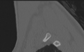 Cervical disc replacement (Radiopaedia 37383-39205 Sagittal bone window 8).png