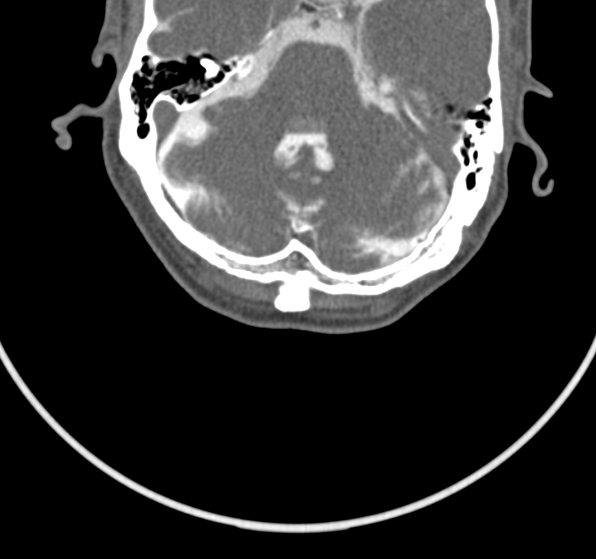 Cervical dural CSF leak on MRI and CT treated by blood patch (Radiopaedia 49748-54996 B 3).png