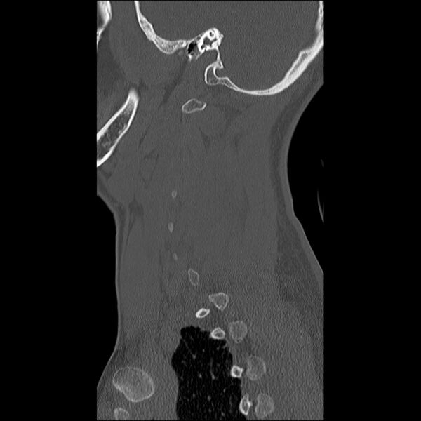 File:Cervical facet fracture and anterior discoligamentous injury (Radiopaedia 32139-33083 Sagittal bone window 3).jpg