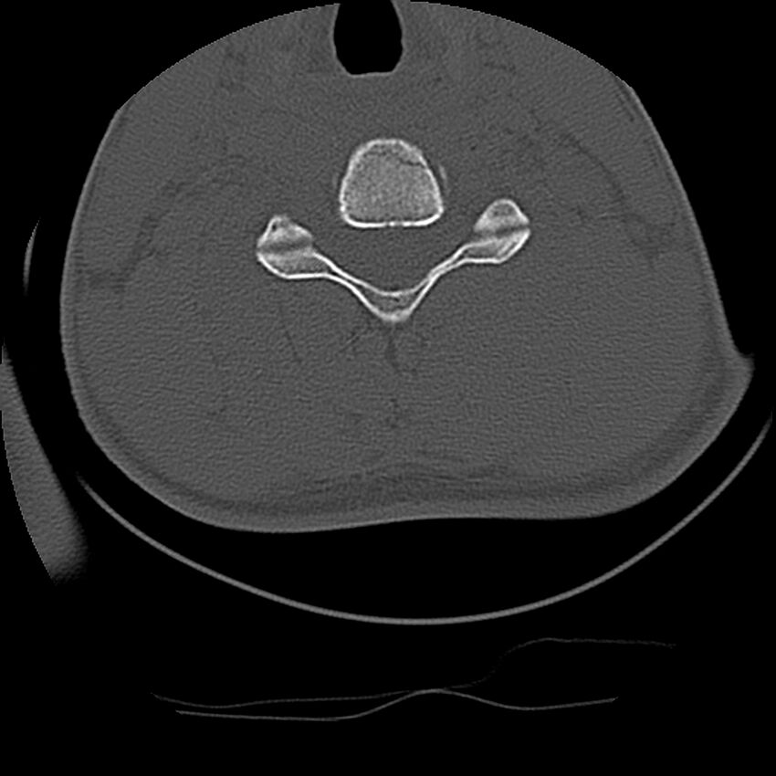 Cervical flexion teardrop fracture with cord hemorrhage (Radiopaedia 32497-33454 Axial bone window 53).jpg