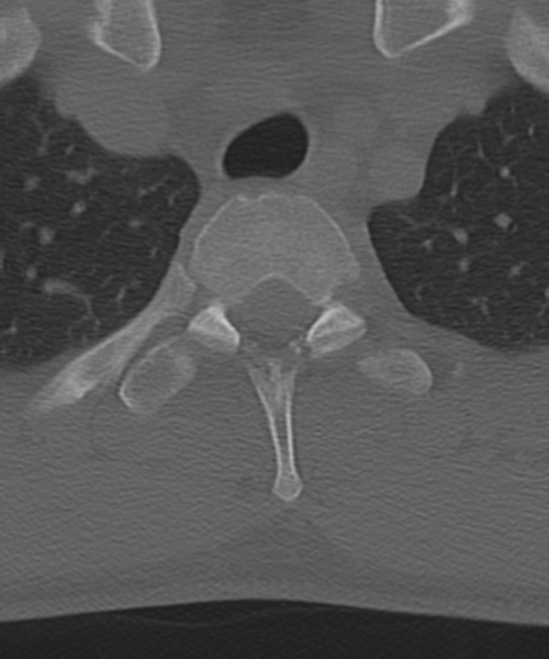 File:Cervical intercalary bone (Radiopaedia 35211-36748 Axial bone window 69).png