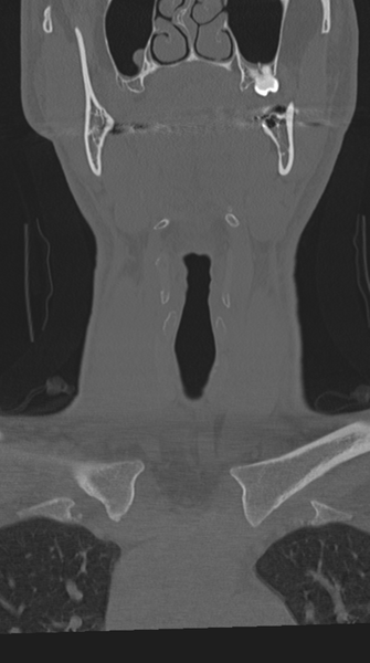 File:Cervical intercalary bone (Radiopaedia 35211-36748 Coronal bone window 7).png
