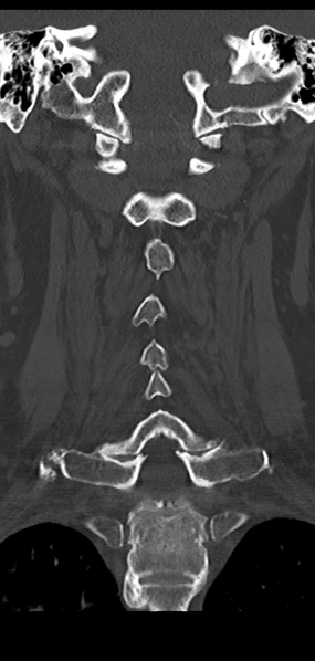 File:Cervical spine fracture - chalk stick (Radiopaedia 39116-41323 Coronal bone window 31).png