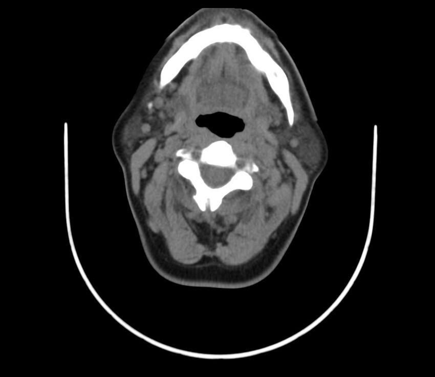 Cervical venous malformation (Radiopaedia 22653-22672 Axial non-contrast 26).jpg