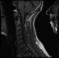 Cervical vertebrae metastasis (Radiopaedia 78814-91667 Sagittal T1 5).png
