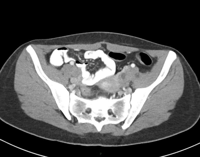 Cesarean scar endometriosis (Radiopaedia 82925-97262 A 67).jpg