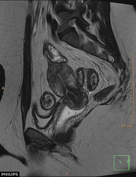 File:Cesarian scar endometriosis (Radiopaedia 68495-78066 Sagittal T2 17).jpg