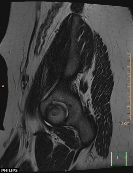 File:Cesarian scar endometriosis (Radiopaedia 68495-78066 Sagittal T2 29).jpg