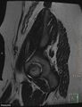 Cesarian scar endometriosis (Radiopaedia 68495-78066 Sagittal T2 29).jpg