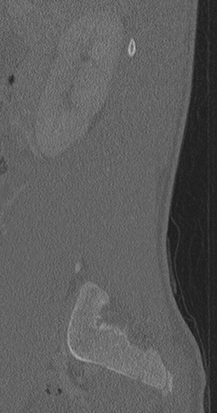 File:Chance fracture (Radiopaedia 40360-42912 Sagittal bone window 79).png