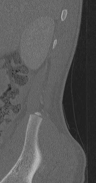 File:Chance fracture (Radiopaedia 40360-42912 Sagittal bone window 97).png