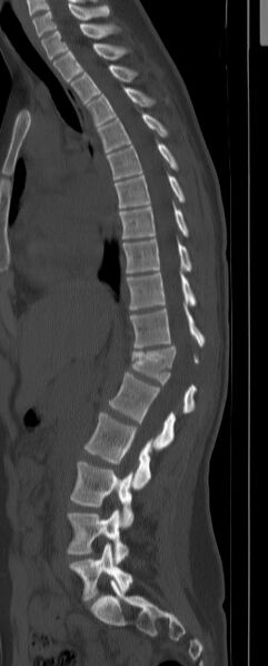 File:Chance fracture (Radiopaedia 45345-49372 Sagittal bone window 9).jpg