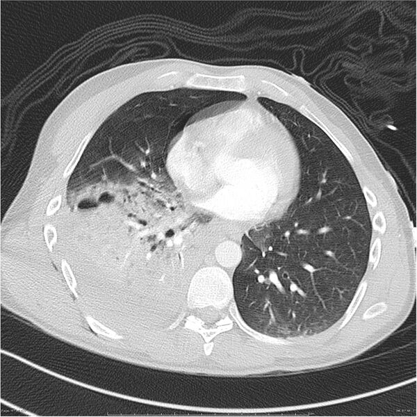 File:Chest and abdomen multi-trauma (Radiopaedia 26294-26425 lung window 67).jpg